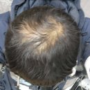 포뷰트 두피타투 내돈내산 후기와 사용 꿀팁 총정리