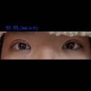 내돈내산 쌍꺼풀재수술 리얼후기 강남쌍수. 압구정쌍수. 오렌지성형외과