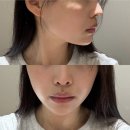 레이저 | 강남 논현 피부과 기미레이저 후기 피부톤까지 맑아진 논현역 피부과