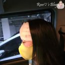 153신경외과의원 | 153신경외과에서 이마에난 표피낭종을 헤어라인쪽 따라들어가 제거함