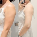 경인로2L | 영등포 지흡주사: 팔 람스 가격 12주차 후기, 붓기 관리와 다이어트 근황