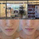 첨단과기로 | 첨단 피부관리 울트라플라 후기 대박임!