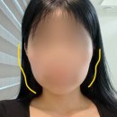 티타늄 리프팅 60KJ + LDM 내돈내산 시술 찐솔직후기