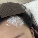 로뎀헤어라인 | 마곡 눈썹문신제거 헤어라인 잔흔제거 마리미뷰티 후기
