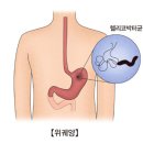 전 세계적으로 가장 많은 암 발병을 일으키는 병원체인 H. pylori(헬리코 박터)에 대해 알아야 할 사항 이미지