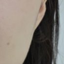 청담란셀의원 | 청담란셀의원 여드름자국 흉터 서브시전 여신티켓 내돈내산 후기