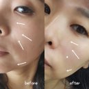 우리들한의원 | 부산 편평사마귀 제거 서면 한의원에서 침으로 확실하게 떼고 온 후기