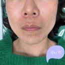 엘라비 | 강남역피부과 강남리투오 스킨부스터 후기, 엘라비에리투오 일주일차 경과