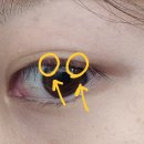 새싹약국 | [공지] 나의 다래끼 째기 수술 3번째 후기 및 경과, 그리고 다 뽑힌 속눈썹