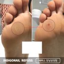 발바닥 티눈 레이저 냉동치료 대신 관리 후기