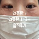 리쥬란 i (리쥬란 아이) 첫 도전 후기 with 리쥬란HB (리쥬란 통증 솔직 후기)