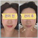 장안남북로 | [의왕삼동피부관리]고주파 스킨타이트닝으로 얼굴업업!"에스떼초이"