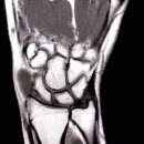 영통척튼튼의원 | 수원손목통증 초기에 관리 하지 않으면 만성 통증으로 (수원 영통척튼튼의원)