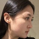 올림피움채움올피채의원 | [강남역피부과] 심부볼 인모드 솔직후기 관리하고 왔어요 전 후 사진 있습니다.