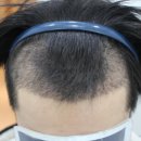 깊은 엠자 넓은 이마 남성 비절개 모발이식 만족스러운 후기! -모더함의원-