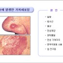 기저 세포암 이미지