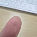 [관평동피부과] 박힌 가시가 안빠치면 지체 말고 피부과 가세요! DS피부과 후기