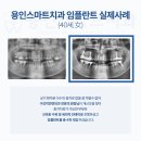김량장동치과에서 시작하는 용인임플란트, 자연치아처럼 편안하게