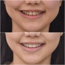 무삭제 라미네이트 젤라미 교정 후 왜소치 잇몸성형 스마일라인 후기 사진 기록