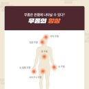 레푸스 이미지
