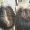 대박헤어 | 강남 헤어라인 SMP 후기 변화가 대박