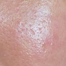 오세대 | 부산 서면 에스테틱 압출 잘하는 곳 여드름 블랙헤드 관리는 오비아에스테틱