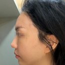 투하트호텔 | 논현동에선 스킨부스터 대신 이거! 자연스럽게 어려지는 하트라인윤곽리프팅