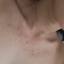 [비룸스킨] 인천 작전동 에스테틱 피부/바디 관리 여드름 관리 후기(피임약 부작용)