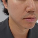 디오레 | 피부과 모공관리 제네시스 레이저 피코프락셀 네오빔 1회차 효과 가격 공유