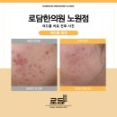 엘라스틴미아사거리역 | 미아사거리역피부과 여드름 흉터 치료 방법(실제 케이스)