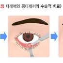 눈속콩다래끼 눈 다래끼 초기 증상 겉다래끼 정리 이미지