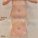 주식회사 스킨앤바디 | 해운대피부관리 레젤스킨앤바디 온D윤핏 리프팅 복부관리 후기