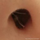 제이팜약국 | 이비인후과 비염수술 한달 후기, 실비보험 청구 완료