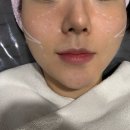 강남역 피부과 울쎄라 300샷 심부볼 중안부 리프팅 내돈내산 솔직후기