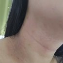 천안베스트원요양병원 | [순천향대피부과 성인아토피] 면역억제제 사이폴엔 4년 복용 후 듀피젠트와 병행 후기 + 실비 청구