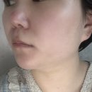 잠실새내역 피부과 온다리프팅 3만줄 후기, 이중턱 라인 정리 제대로 된 느낌