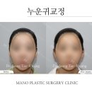 마노 성형외과 귀성형 후기 및 누운귀 교정 방법 알아보기