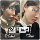 삼주메타 | 신사역피부과 콜라겐주사 스컬트라로 시술 효과 본 후기