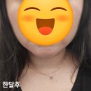 미앤서울치과의원 | 쓰레드에 올라온 병원 직접 가봄｜신사역 뷰티앤영의원 뷰컷주사 내돈내산 후기