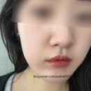 셀앤비에스테틱강남지점 | 선릉피부관리 셀앤비에스테틱 강남선릉점 블랙헤드 제거 각질 여드름 피지 케어 후기