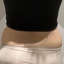 바디온다 복부 120kJ 후기 강남구청역피부과 솔린의원 바디리프팅
