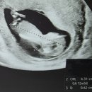 반포알약국 | [임신종결] 12주차 다운증후군 확진, 소파술 후기