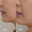 웨이브 | 강남역 피부과 : 힐로웨이브 후기♩ 콜라겐 스킨부스터