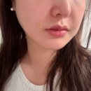 현대자동차그린서비스사정점 | 강남역 피부과에서 받은 쥬베룩볼륨 4cc 팔자주름 내돈내산 솔직 후기