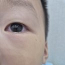 [의정부] 튼튼어린이병원 가와사키병 6박7일 입원기, 현대해상 보험 청구 후기