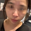 삼성동-2 | 삼성동피부과 피코토닝 2회차 후기