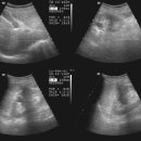 Lt. renal cyst 이미지