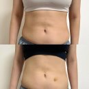 모스비 - 김포시 봉화로167번길 35-7 | 복부 지방분해주사 가격 성분 꼼꼼히 비교하고 받은 2차 후기
