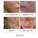 다인한의원 | 부천지루성피부염 한의원, 클렌징 오일이 왜 더 악화시킬까요?