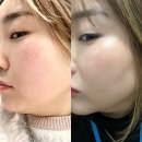 희영메디칼 | 송도피부과 3D코어리프팅 내돈내산 후기와 효과